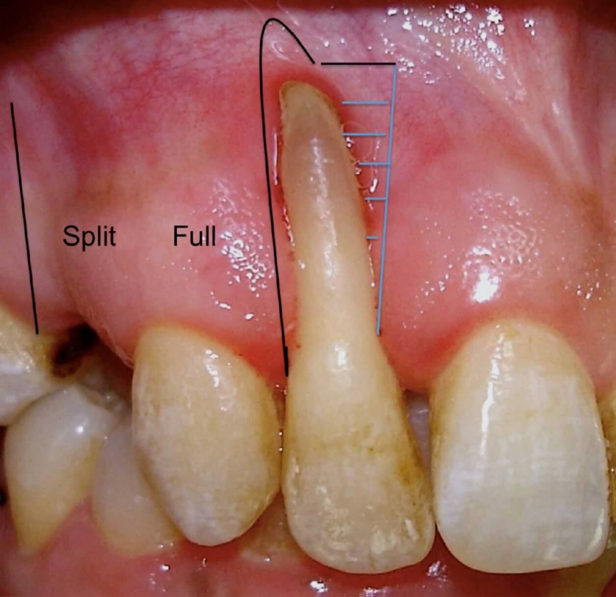 exposed tooth root