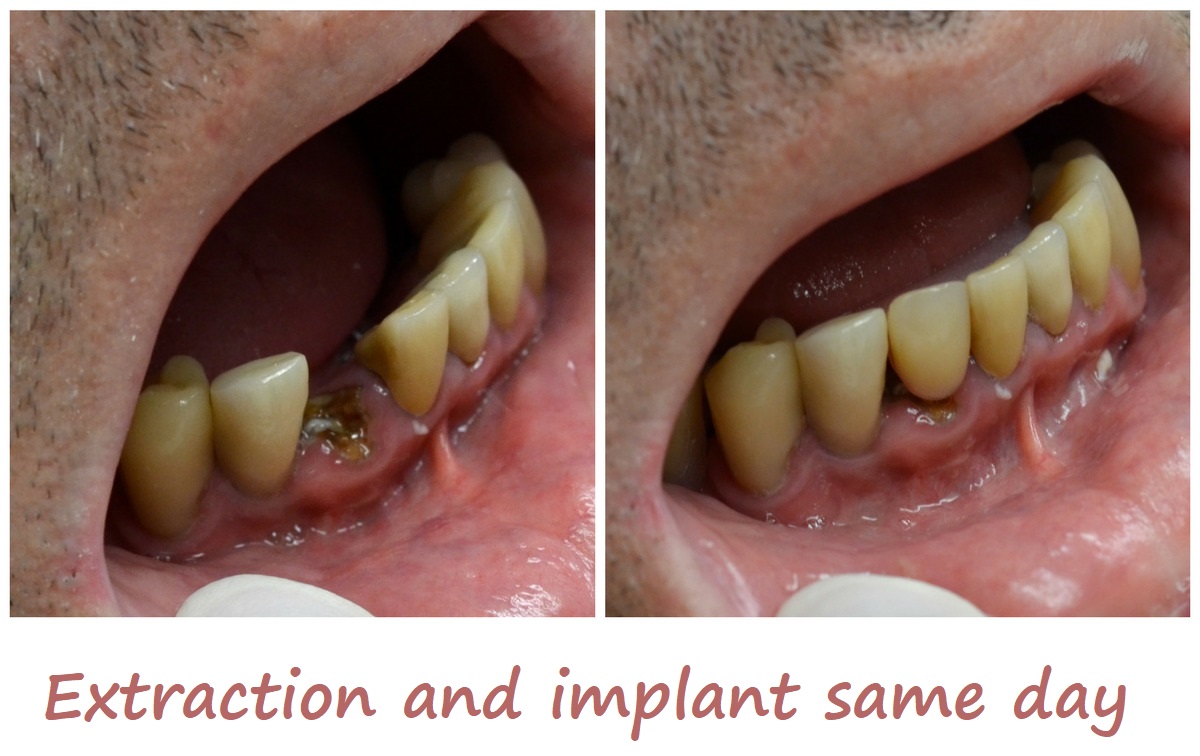 Extraction and implant same day