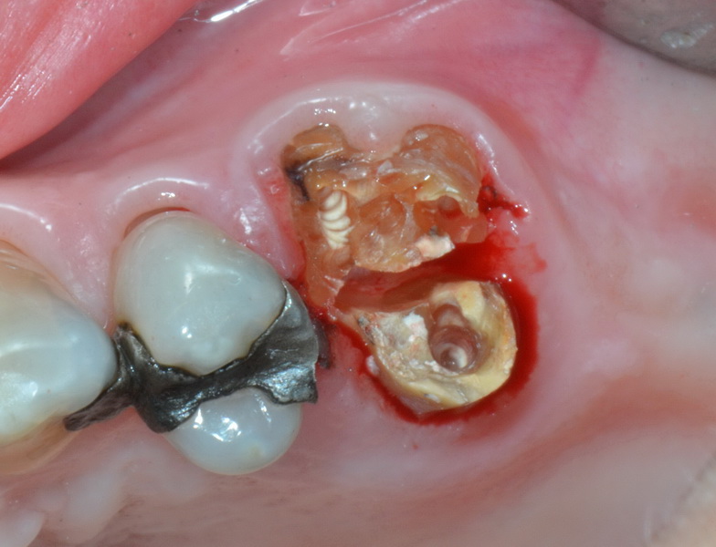 Extraction of crowned tooth