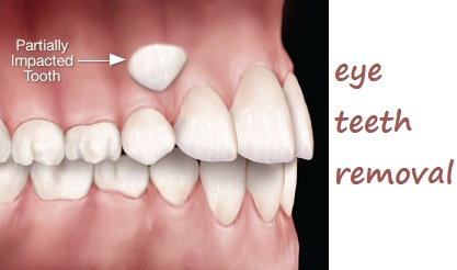 eye teeth removal