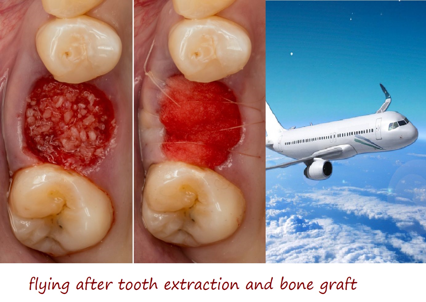 Flying After Tooth Extraction And Bone Graft