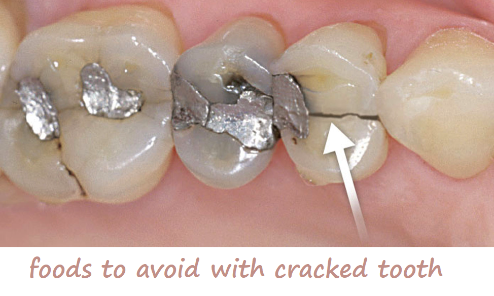 foods to avoid with cracked tooth