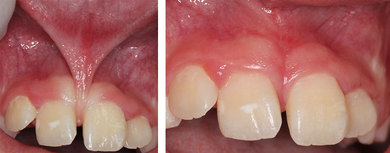 Frenectomy Procedure