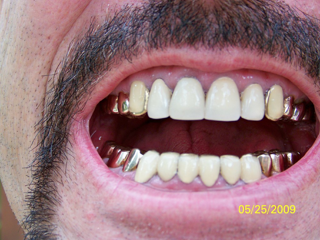 front teeth crowns