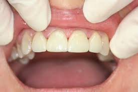 front teeth crowns