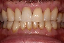 front teeth crowns