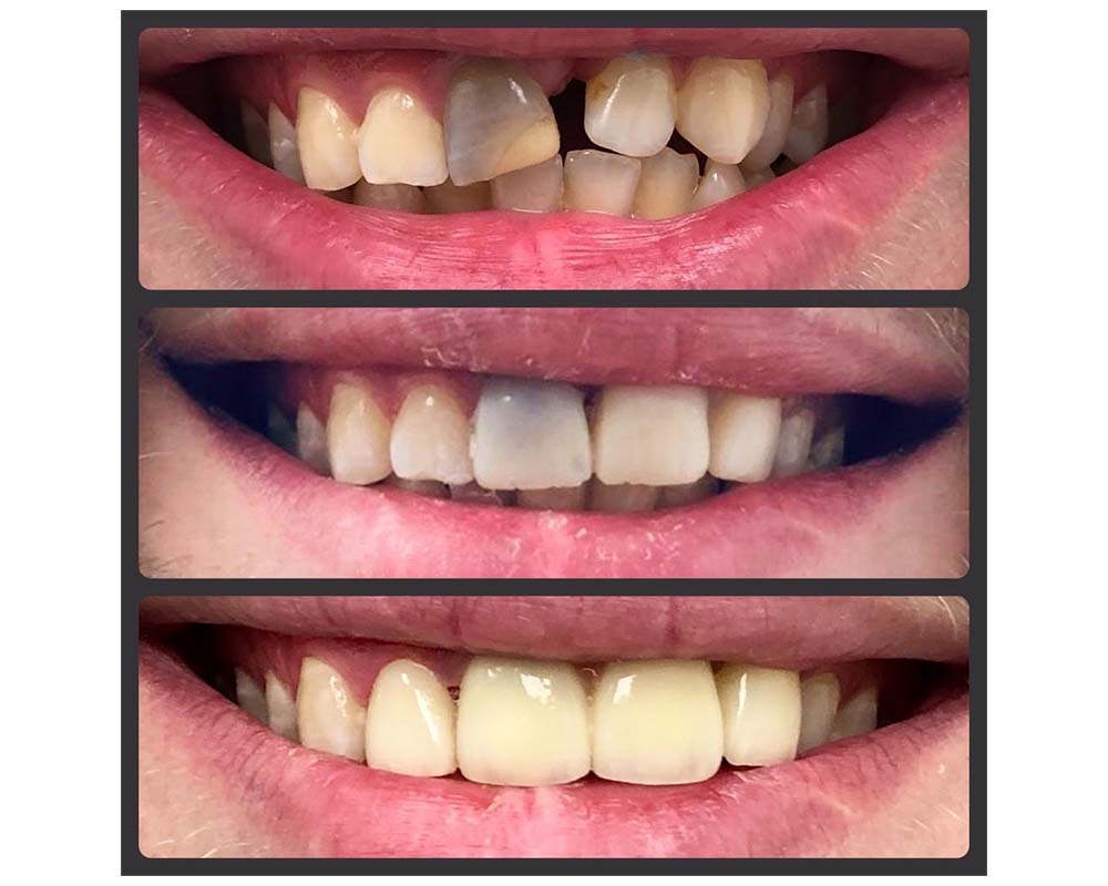 Placement of Crown on front tooth