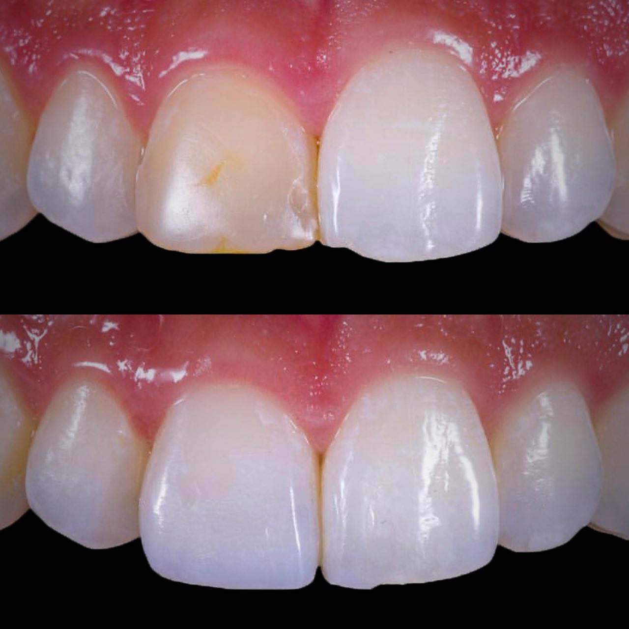 Front tooth crown for discolored tooth. before and after picture.