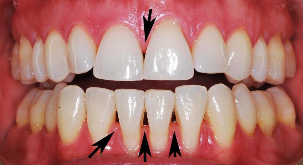 gaps in teeth after deep cleaning