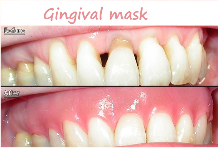 gingival mask