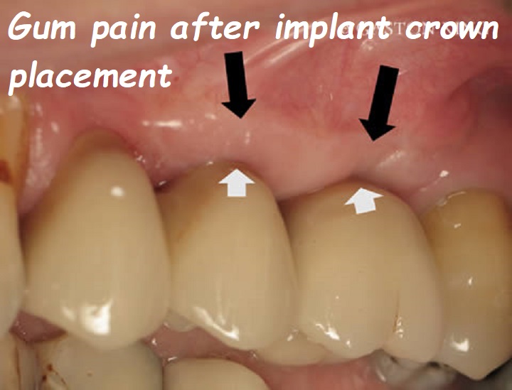 Gum pain after implant crown placement