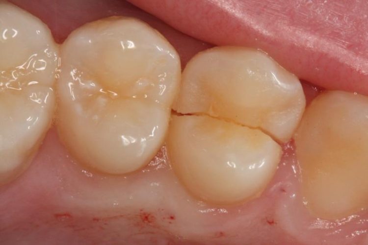 hairline cracks in teeth