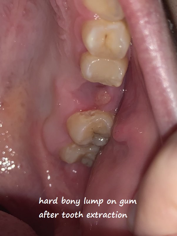 hard bony lump on gum after tooth extraction