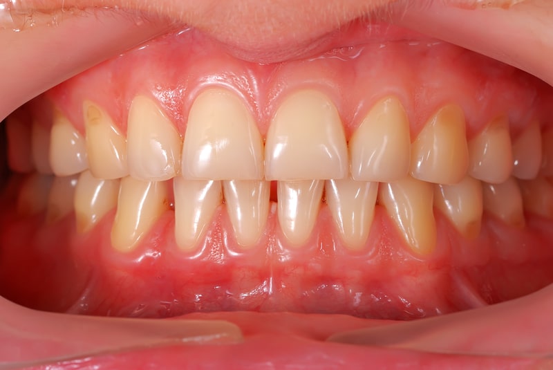 healthy gums color