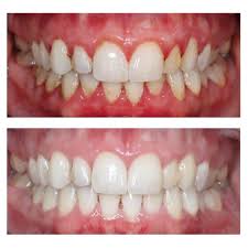 healthy gums vs unhealthy gums