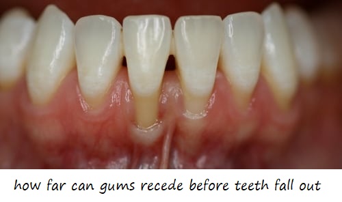 how far can gums recede before teeth fall out