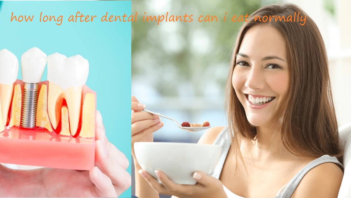 how long after dental implants can i eat normally