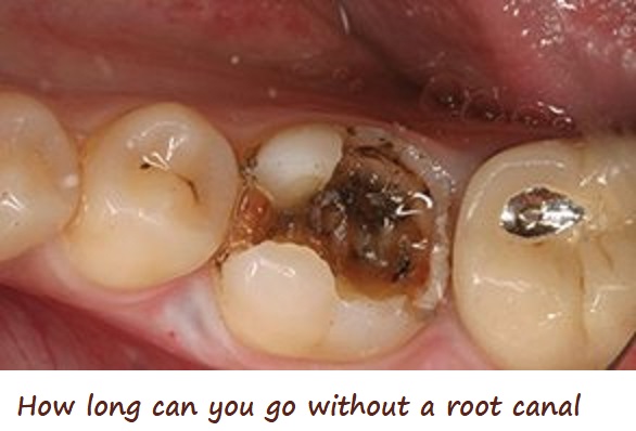 How long can you go without a root canal