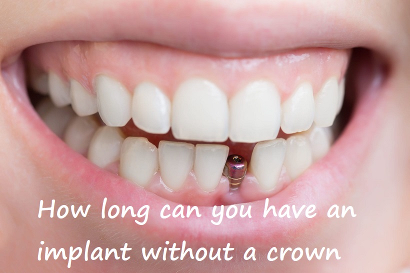 How long can you have an implant without a crown