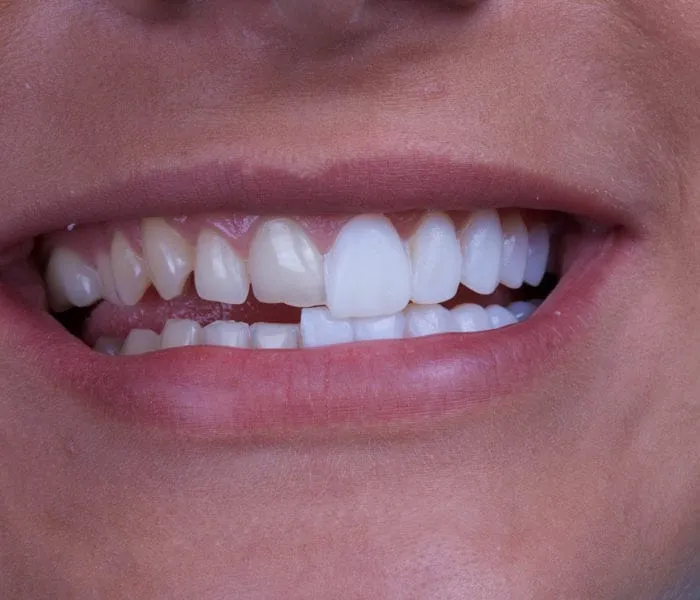 how long do veneers last