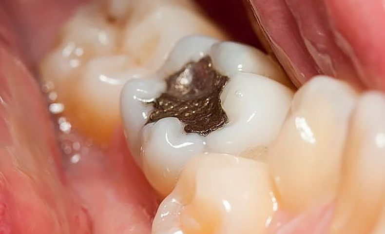 how long does a cavity filling take