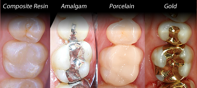 how long does a cavity filling take