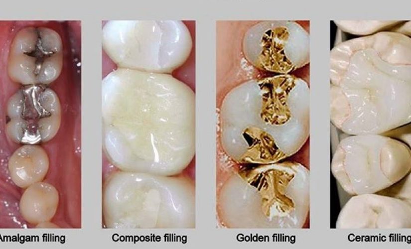 how long does a cavity filling take