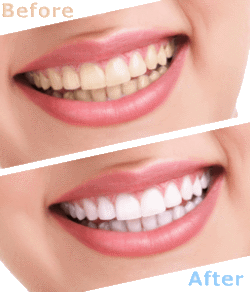 how long does teeth whitening last