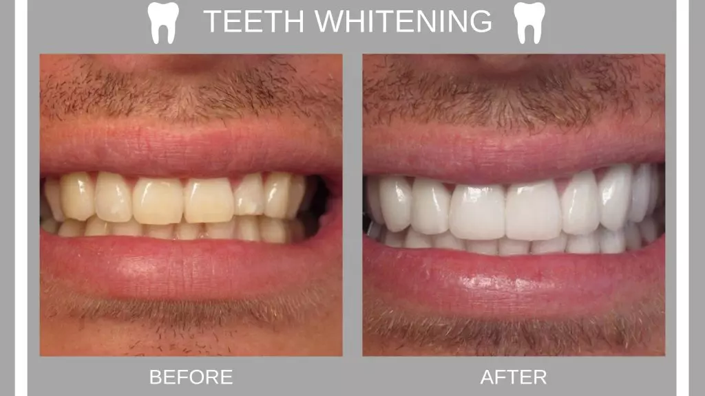 how long does teeth whitening last