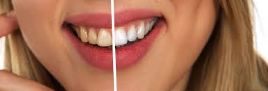 how long does teeth whitening last