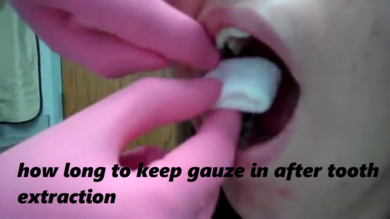 how long to keep gauze in after tooth extraction