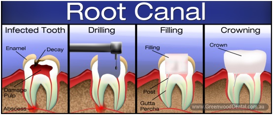 how long to wait for permanent filling after root canal