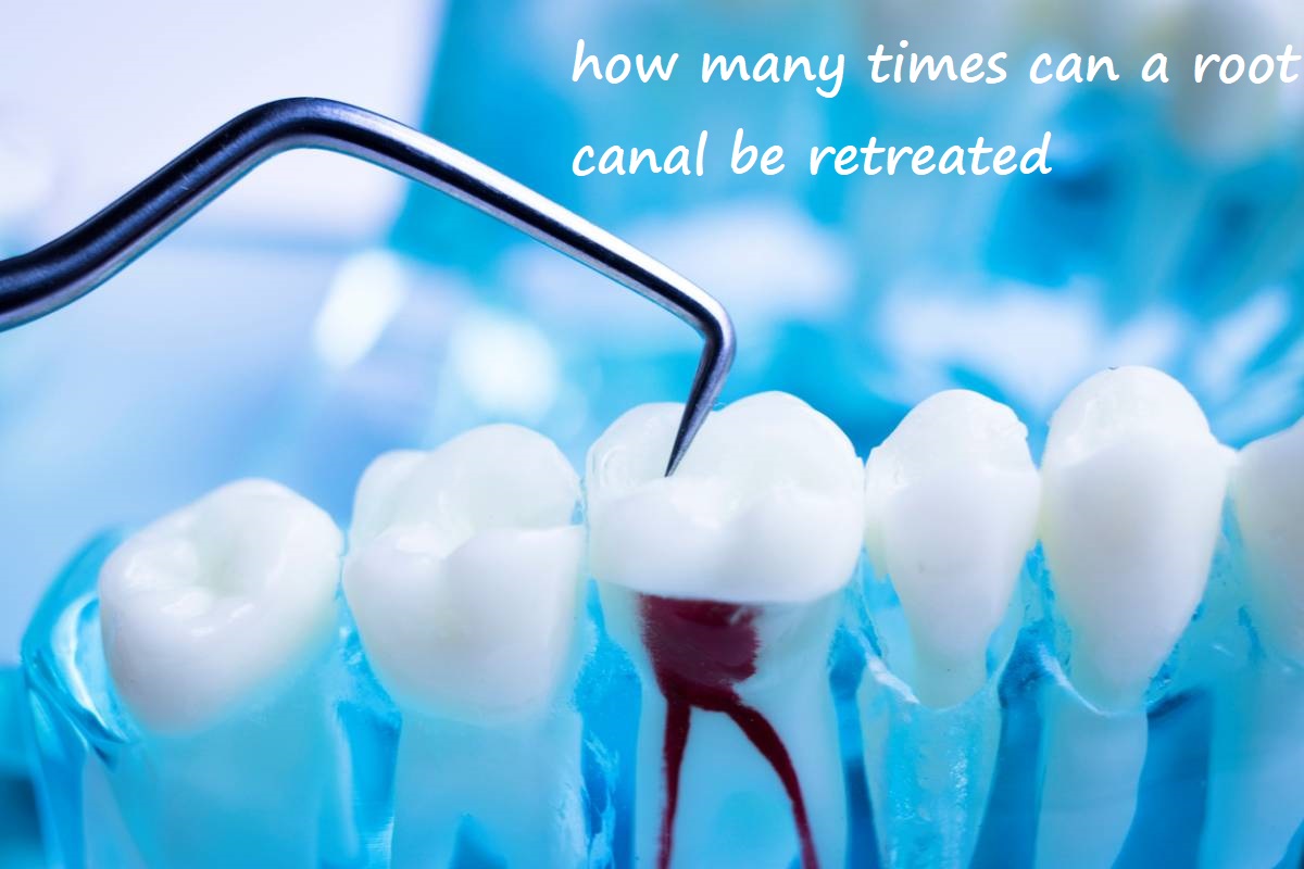 how many times can a root canal be retreated