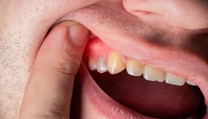 how to drain a tooth abscess at home