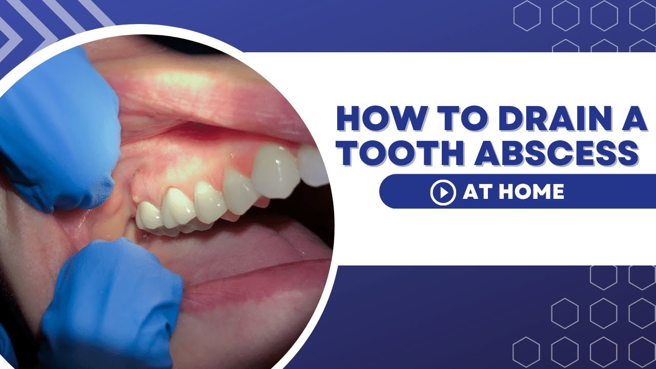 how to drain a tooth abscess at home