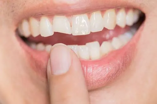 how to fix a chipped tooth at home