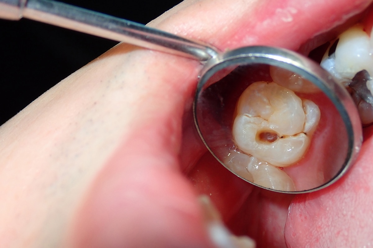 how to fix a cracked tooth naturally