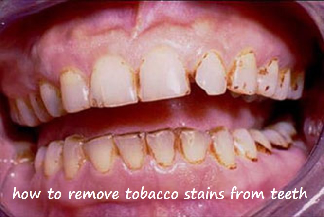 how to remove tobacco stains from teeth