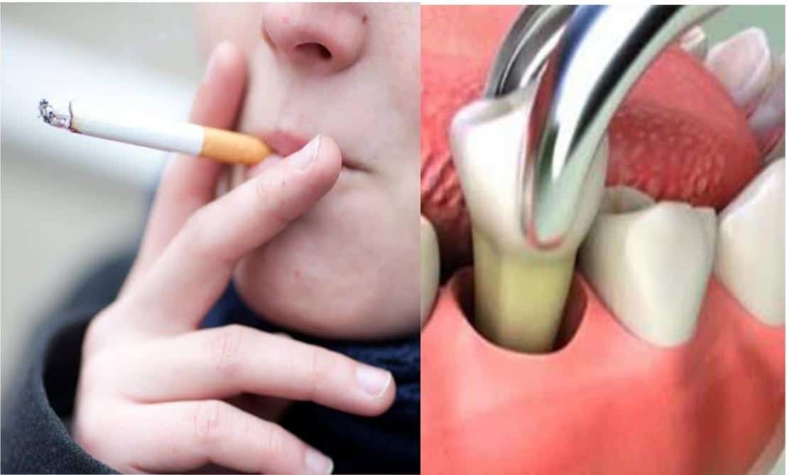 how to smoke after tooth extraction without getting dry socket