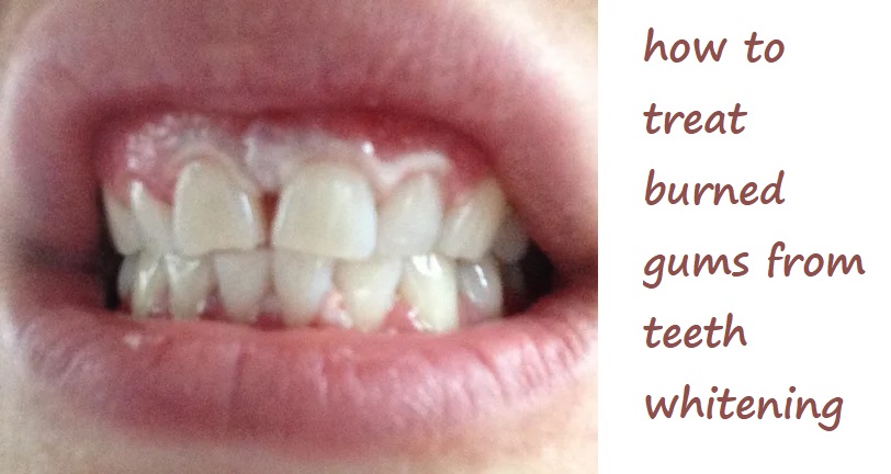 how to treat burned gums from teeth whitening