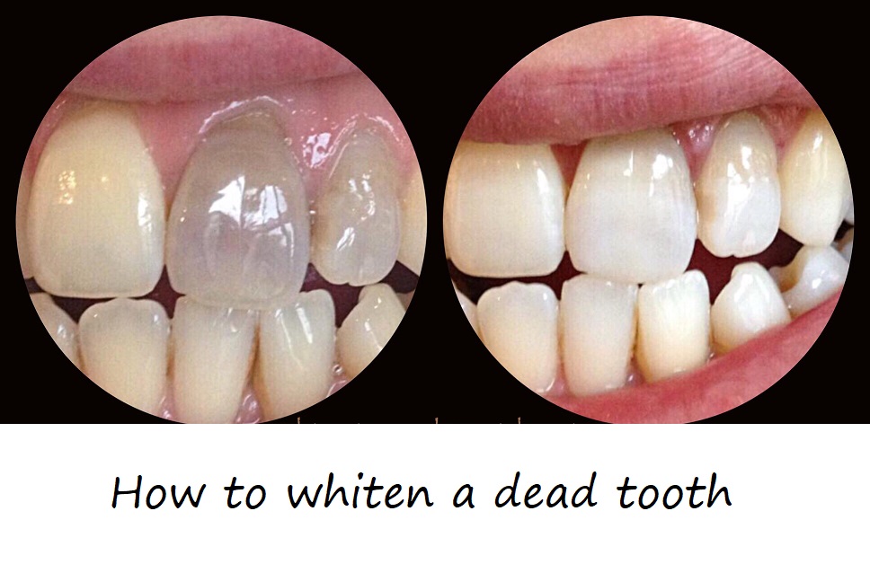 how to whiten a dead tooth