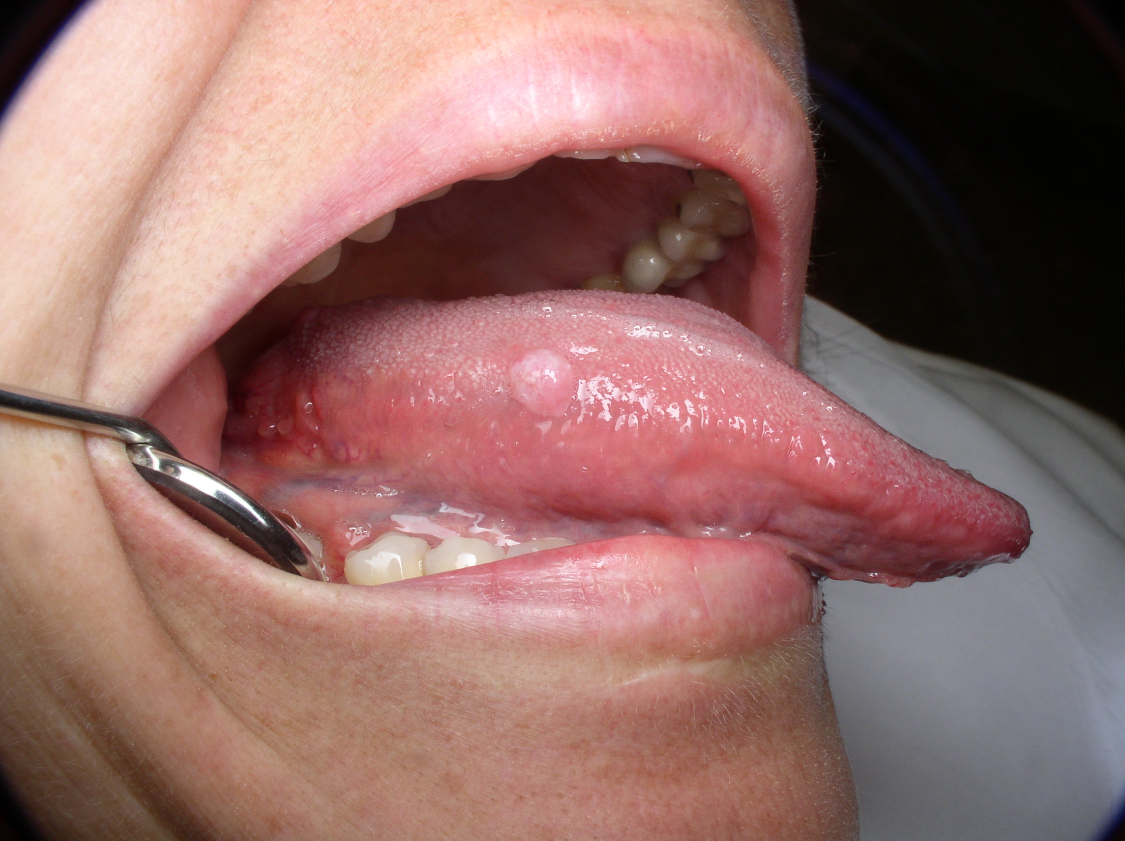 hpv bump on back of tongue Detection of human 