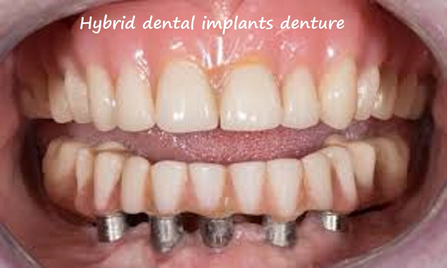 hybrid dental implants