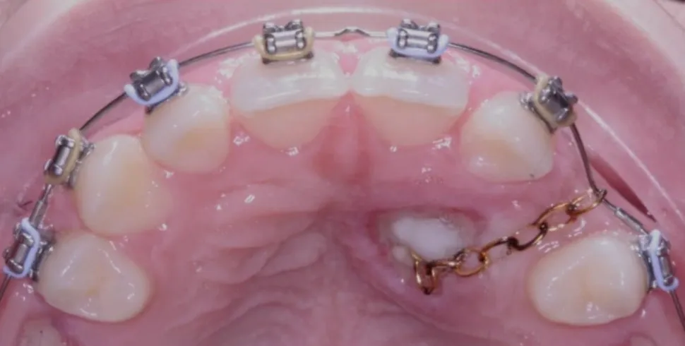 impacted canine tooth braces