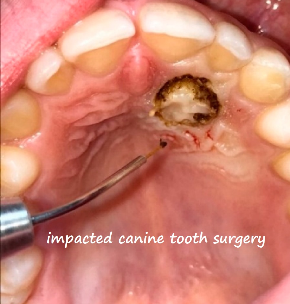 impacted canine tooth surgery