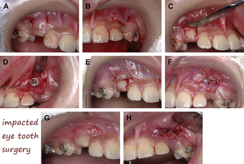 impacted eye tooth surgery