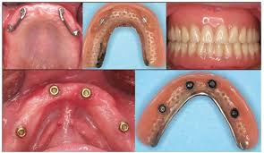 implant overdenture steps