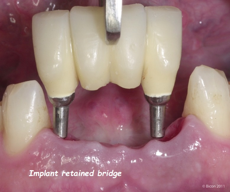 Implant retained bridge