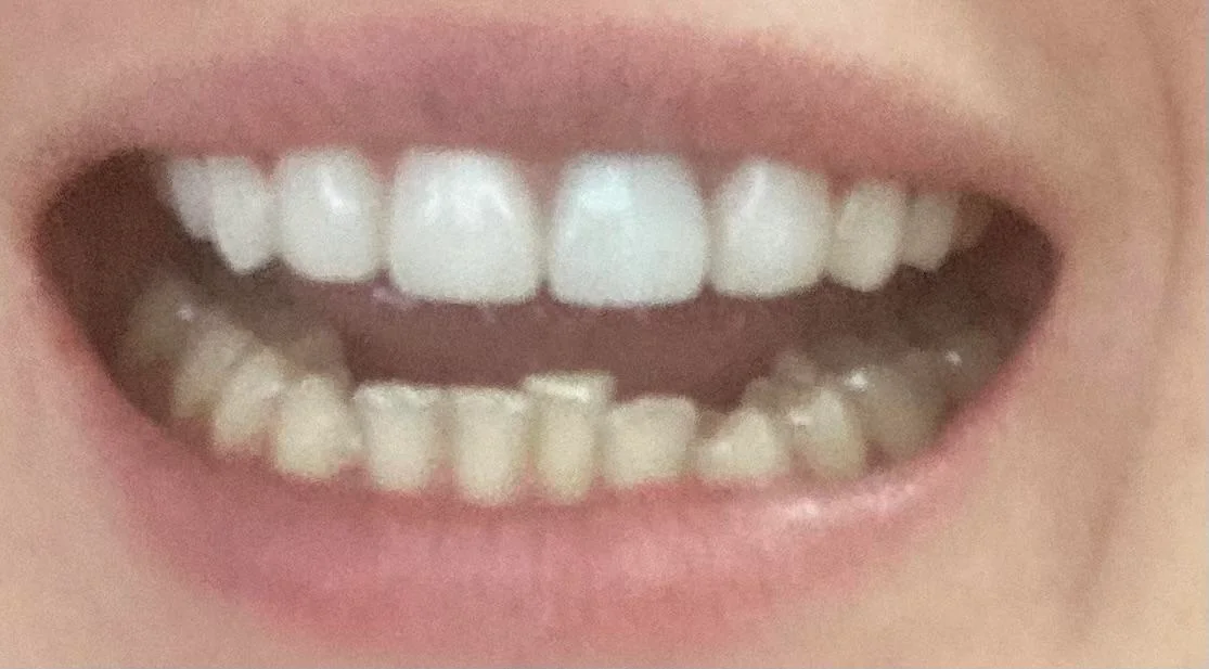 invisalign for only bottom teeth