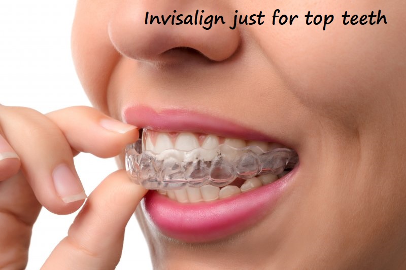 invisalign just for top teeth